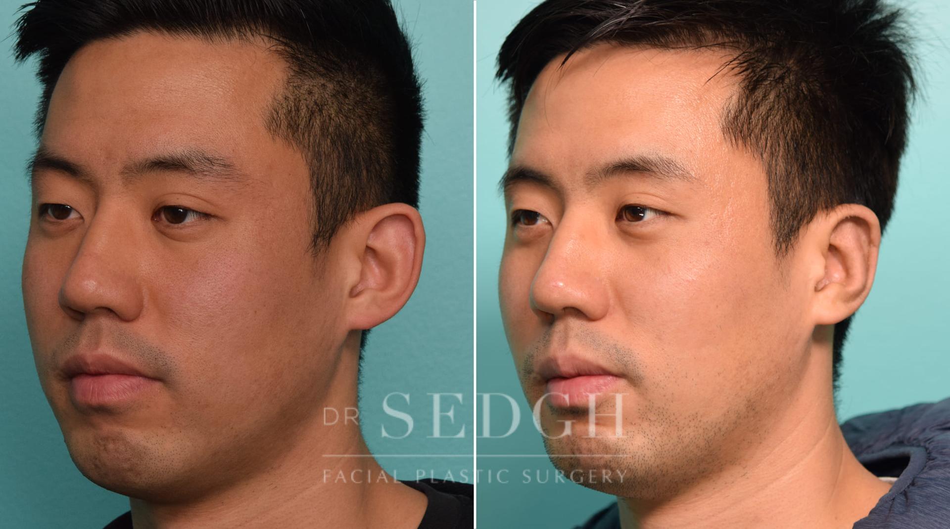 Dr. Sedgh Facial Plastic Surgery ear pinning result — West Hollywood, CA