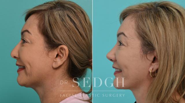 Facelift result at Dr. Sedgh Facial Plastic Surgery in West Hollywood, CA