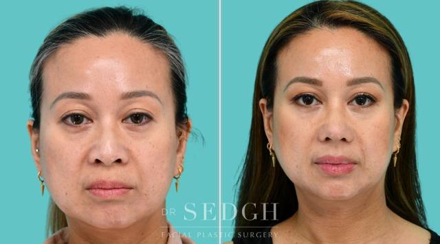Facelift result at Dr. Sedgh Facial Plastic Surgery in West Hollywood, CA