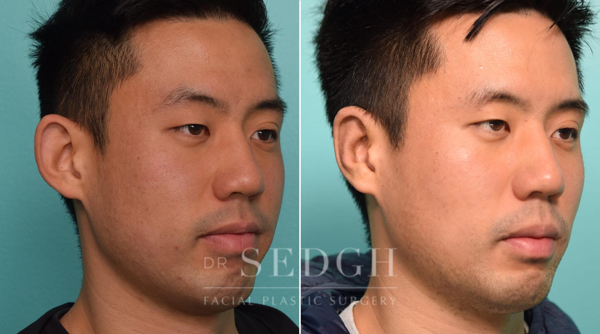 Dr. Sedgh Facial Plastic Surgery ear pinning result — West Hollywood, CA
