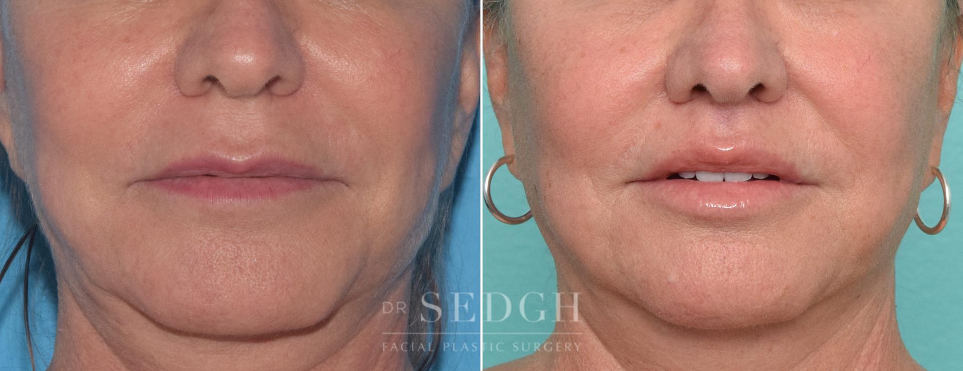 Dr. Sedgh Facial Plastic Surgery lip lift result — West Hollywood, CA