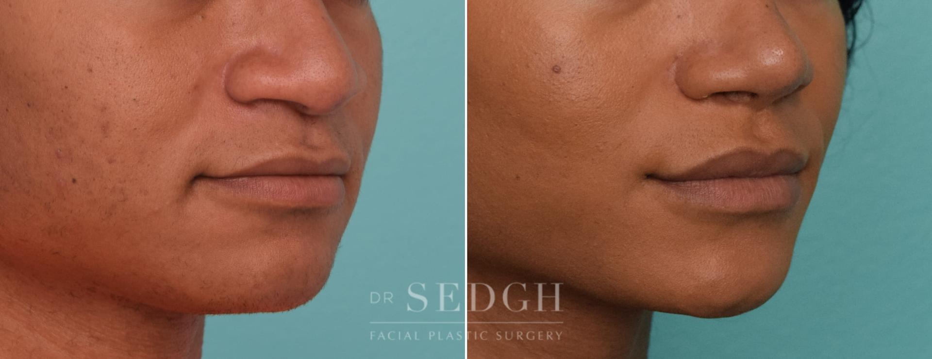 Dr. Sedgh Facial Plastic Surgery lip lift result — West Hollywood, CA