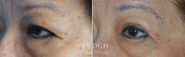 Blepharoplasty result at Dr. Sedgh Facial Plastic Surgery in West Hollywood, CA
