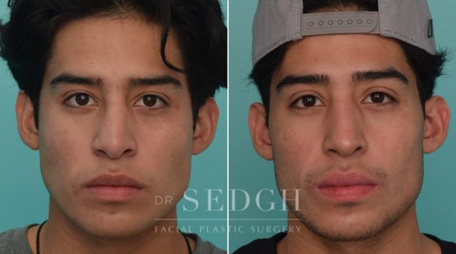 Rhinoplasty result at Dr. Sedgh Facial Plastic Surgery in West Hollywood, CA