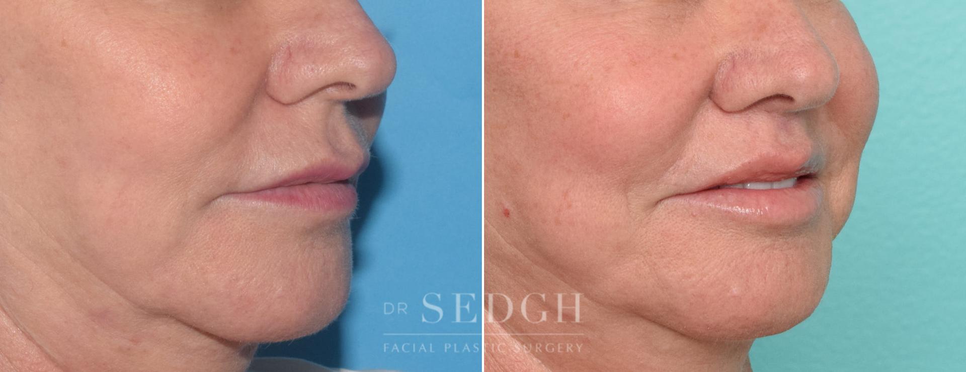 Dr. Sedgh Facial Plastic Surgery lip lift result — West Hollywood, CA