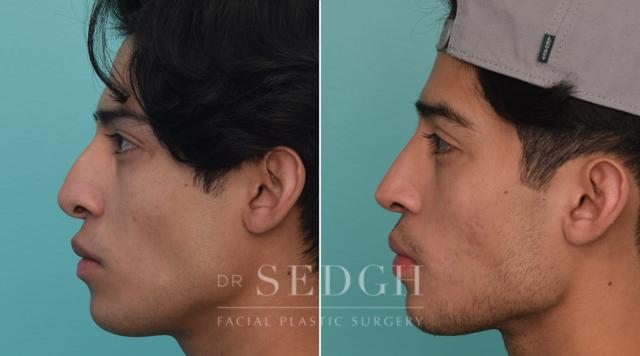 Rhinoplasty result at Dr. Sedgh Facial Plastic Surgery in West Hollywood, CA