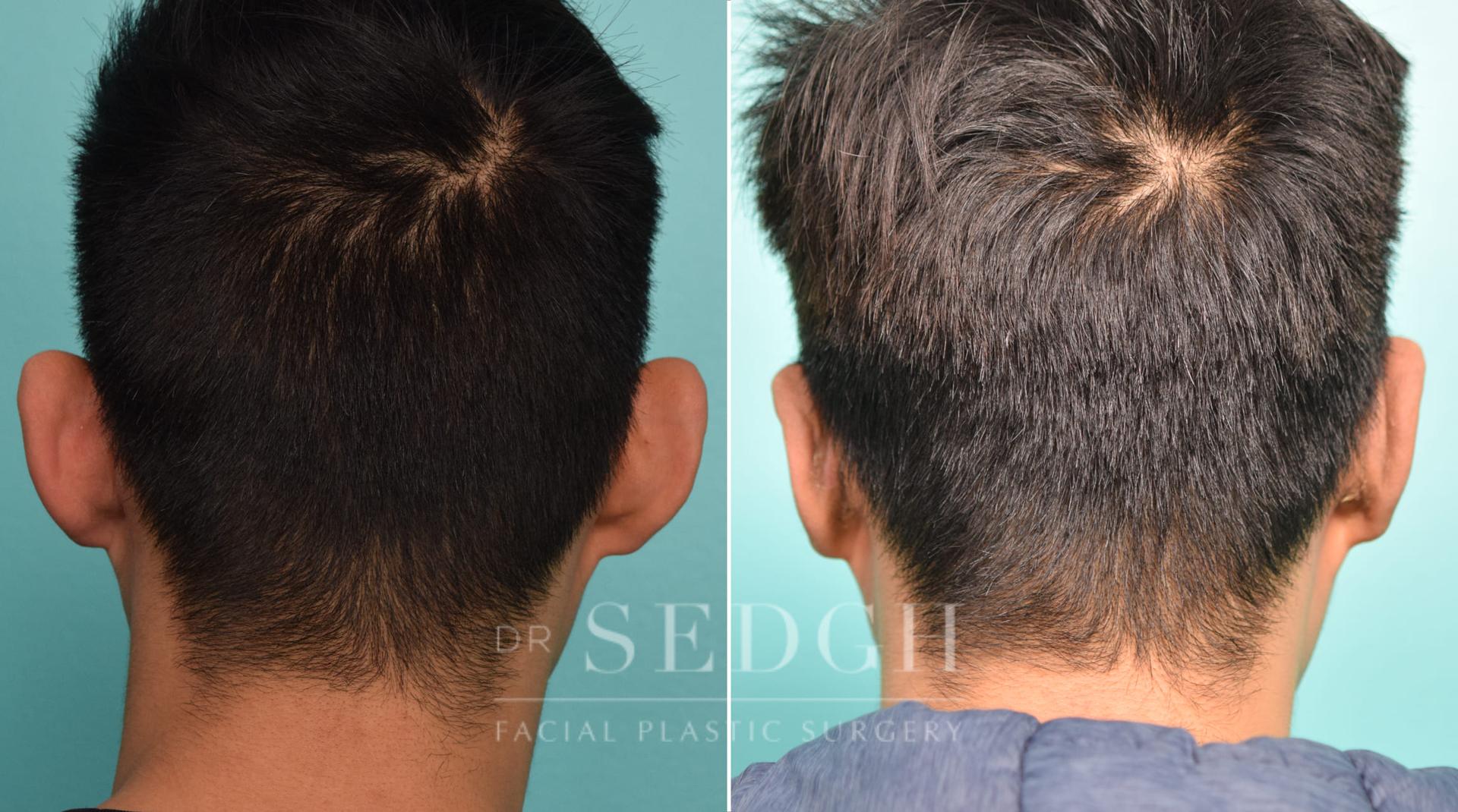 Dr. Sedgh Facial Plastic Surgery ear pinning result — West Hollywood, CA