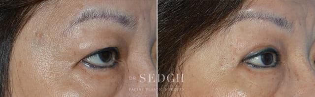 Blepharoplasty result at Dr. Sedgh Facial Plastic Surgery in West Hollywood, CA