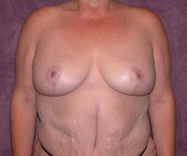 James Boynton, MD breast reduction after — Houston, TX
