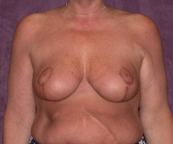 James Boynton, MD breast reduction after — Houston, TX