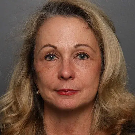 Facelift after at Angela Keen | Utah Aesthetic Surgery in Cottonwood Heights, UT