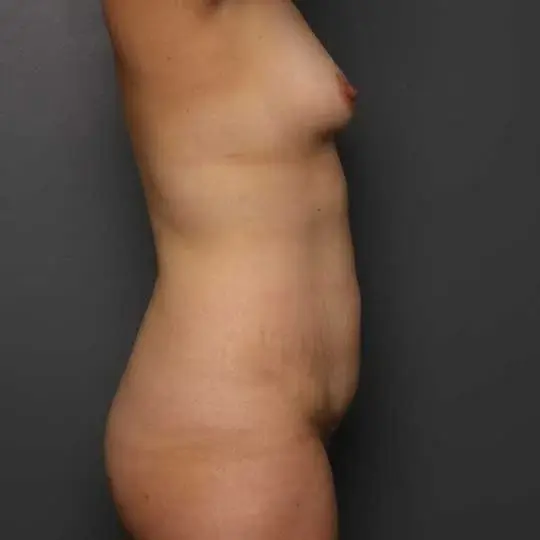 Mini Tummy Tuck before at Angela Keen | Utah Aesthetic Surgery in Cottonwood Heights, UT
