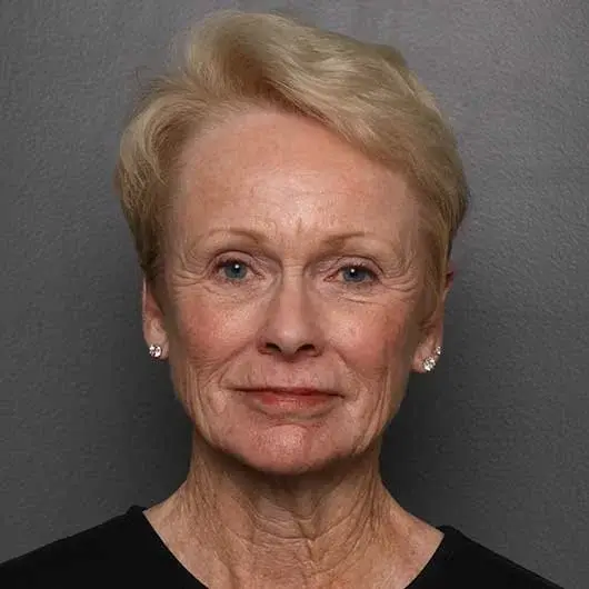 Facelift before at Angela Keen | Utah Aesthetic Surgery in Cottonwood Heights, UT