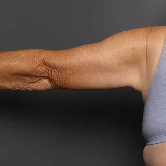 Arm Lift after at Angela Keen | Utah Aesthetic Surgery in Cottonwood Heights, UT