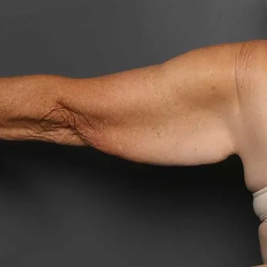 Arm Lift before at Angela Keen | Utah Aesthetic Surgery in Cottonwood Heights, UT