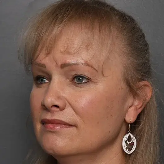 Angela Keen | Utah Aesthetic Surgery lip lift after — Cottonwood Heights, UT