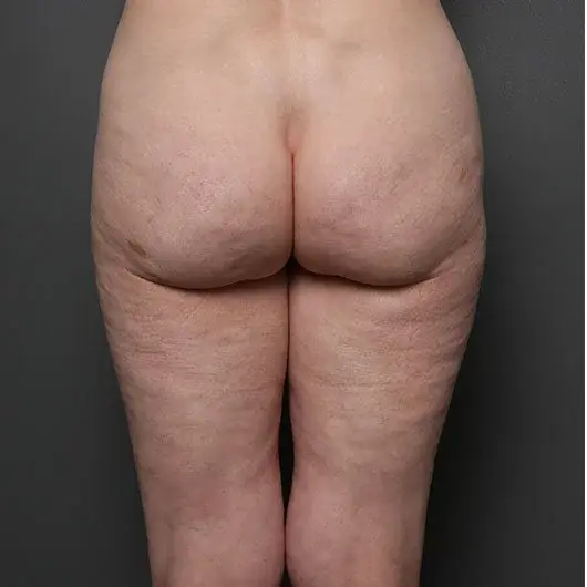 Liposuction after at Angela Keen | Utah Aesthetic Surgery in Cottonwood Heights, UT