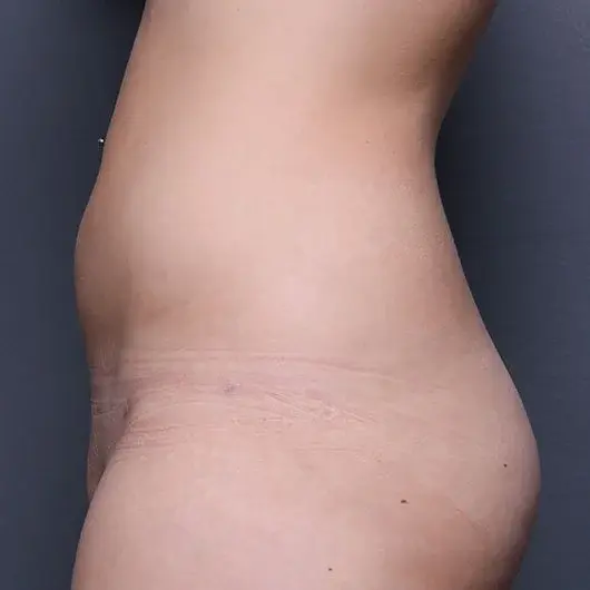 Liposuction after at Angela Keen | Utah Aesthetic Surgery in Cottonwood Heights, UT