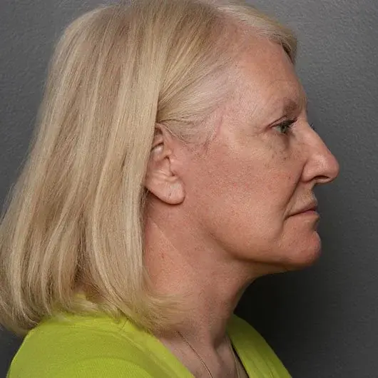 Angela Keen | Utah Aesthetic Surgery neck lift after — Cottonwood Heights, UT