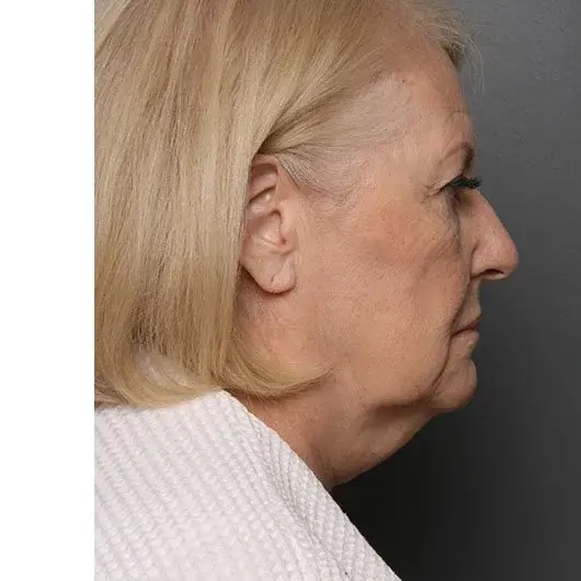Neck Lift before at Angela Keen | Utah Aesthetic Surgery in Cottonwood Heights, UT