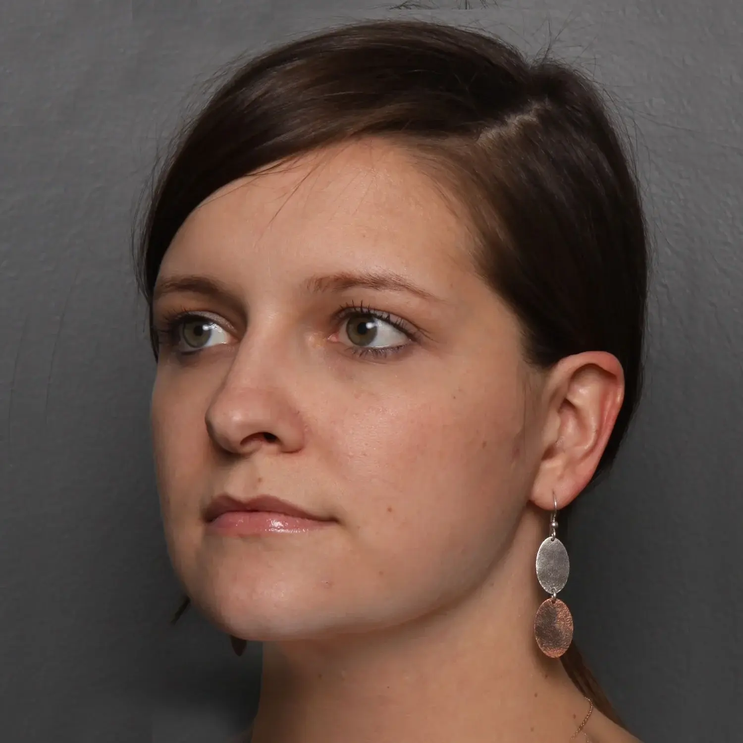 Angela Keen | Utah Aesthetic Surgery neck lift after — Cottonwood Heights, UT