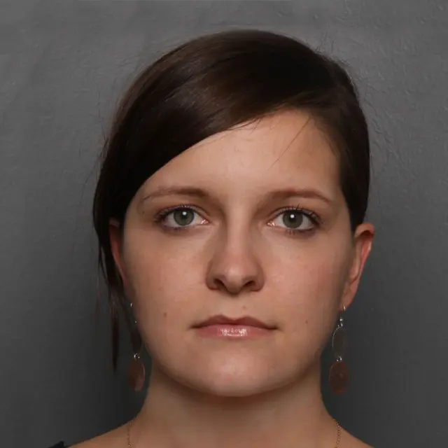 Neck Lift after at Angela Keen | Utah Aesthetic Surgery in Cottonwood Heights, UT