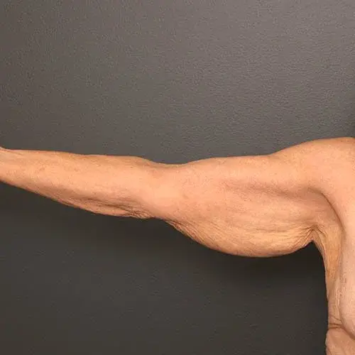 Arm Lift before at Angela Keen | Utah Aesthetic Surgery in Cottonwood Heights, UT