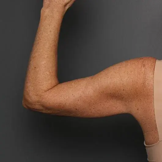 Arm Lift after at Angela Keen | Utah Aesthetic Surgery in Cottonwood Heights, UT