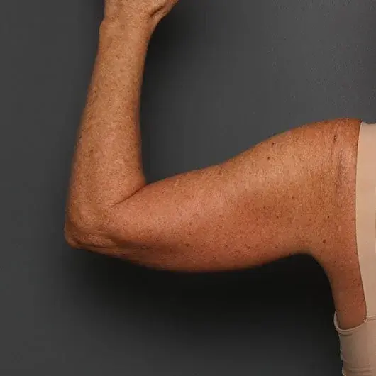 Arm Lift before at Angela Keen | Utah Aesthetic Surgery in Cottonwood Heights, UT