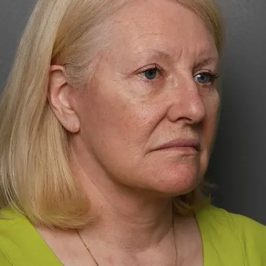 Neck Lift after at Angela Keen | Utah Aesthetic Surgery in Cottonwood Heights, UT