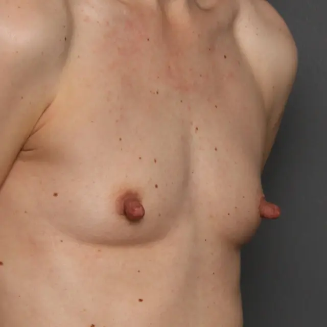 Breast Augmentation before at Angela Keen | Utah Aesthetic Surgery in Cottonwood Heights, UT