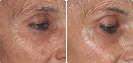 Laser Clinique (P. Alexander Ataii, MD) laser treatment result — San Diego, CA
