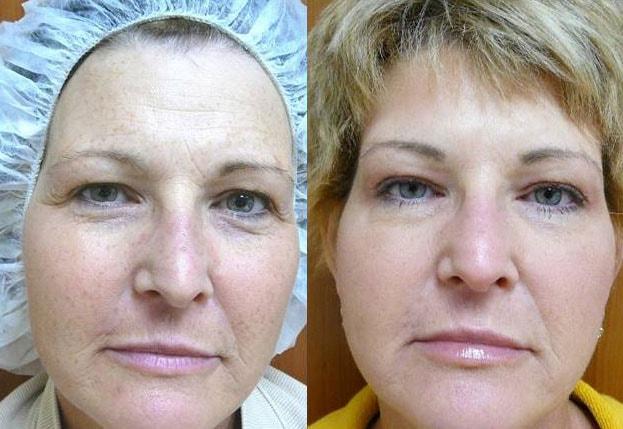 Laser Clinique (P. Alexander Ataii, MD) laser treatment result — San Diego, CA