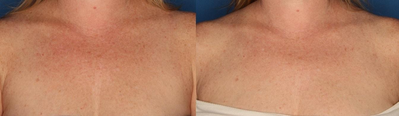 Laser Clinique (P. Alexander Ataii, MD) photofacial result — San Diego, CA