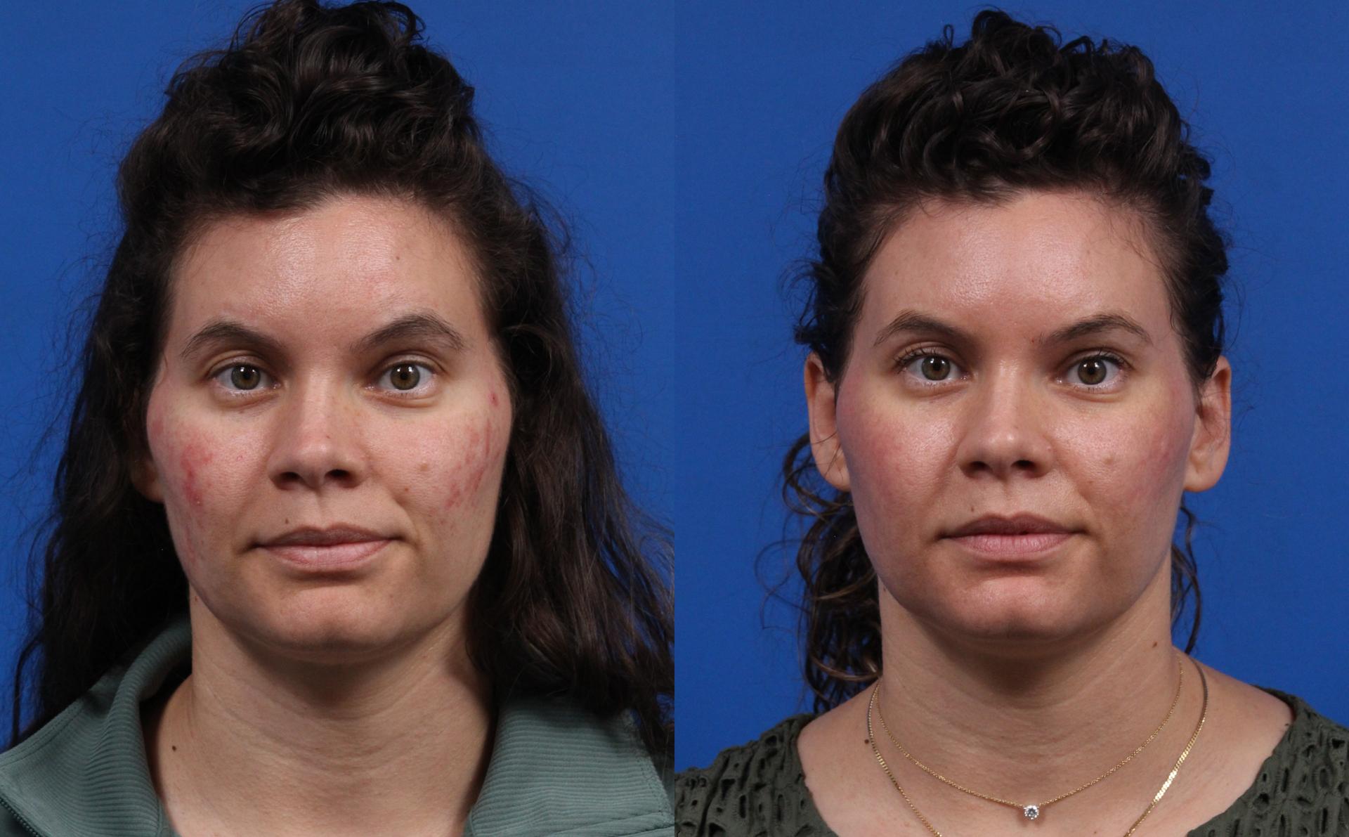 Laser Clinique (P. Alexander Ataii, MD) laser treatment result — San Diego, CA