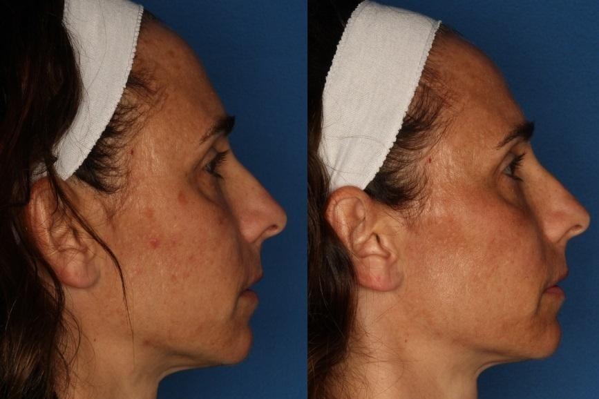 Laser Clinique (P. Alexander Ataii, MD) photofacial result — San Diego, CA