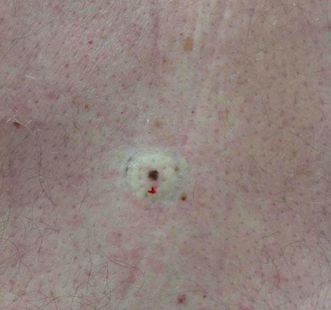Center for Dermatology Cosmetic and Laser Surgery after — Milpitas, CA