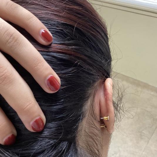 Center for Dermatology Cosmetic and Laser Surgery scar treatment after — Milpitas, CA