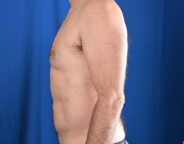 Gynecomastia Surgery after at Millard Plastic Surgery in Englewood, CO