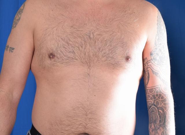 Gynecomastia Surgery after at Millard Plastic Surgery in Englewood, CO