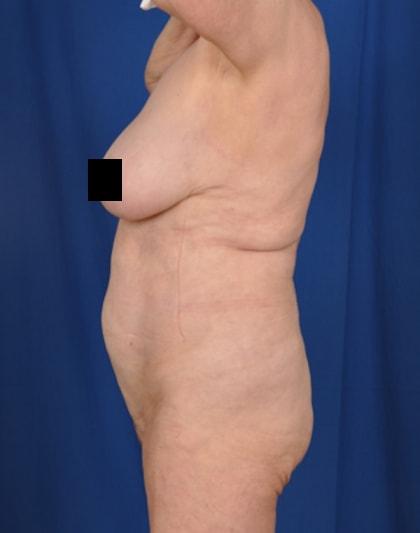 Liposuction after at Millard Plastic Surgery in Englewood, CO