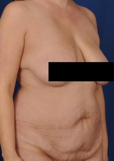 Mommy Makeover before at Millard Plastic Surgery in Englewood, CO