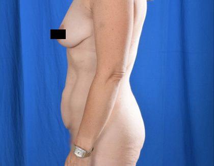 Mommy Makeover before at Millard Plastic Surgery in Englewood, CO
