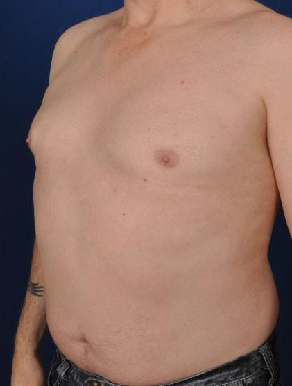 Gynecomastia Surgery after at Millard Plastic Surgery in Englewood, CO