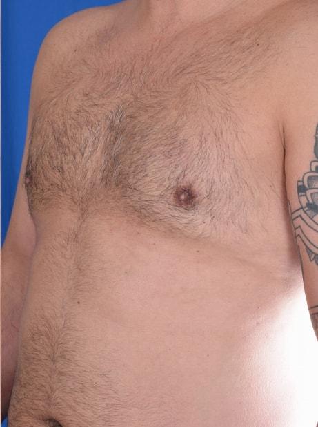 Gynecomastia Surgery after at Millard Plastic Surgery in Englewood, CO