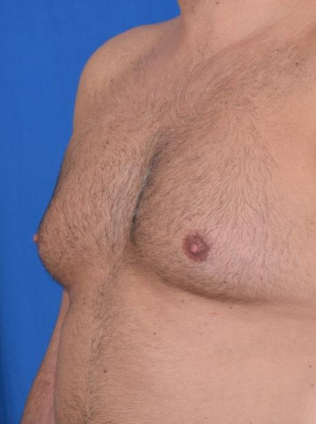 Gynecomastia Surgery before at Millard Plastic Surgery in Englewood, CO