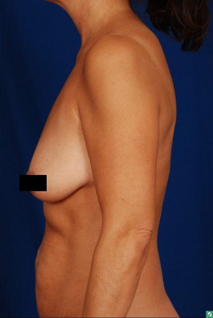 Mommy Makeover before at Millard Plastic Surgery in Englewood, CO
