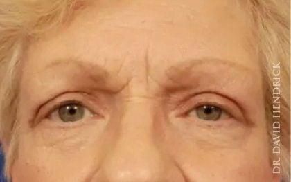 Millard Plastic Surgery after — Englewood, CO