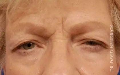 Blepharoplasty before at Millard Plastic Surgery in Englewood, CO