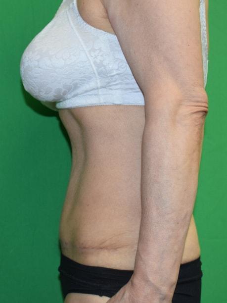 Mini Tummy Tuck after at Millard Plastic Surgery in Englewood, CO